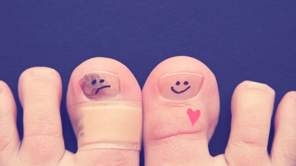 o unghie cu ciuperca si una sanatoasa